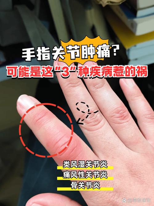 类风湿性关节炎厉害吗