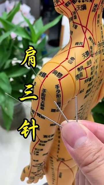 针灸治疗肩周炎的穴位