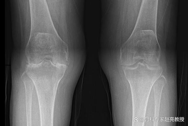 类风湿性关节炎换关节