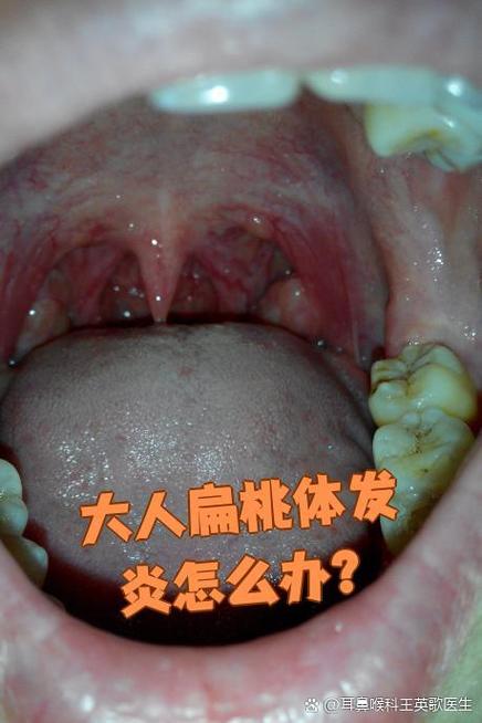 扁桃体炎类风湿关节炎