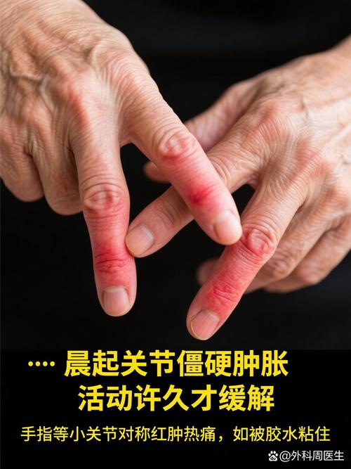 类风湿性关节炎的特征