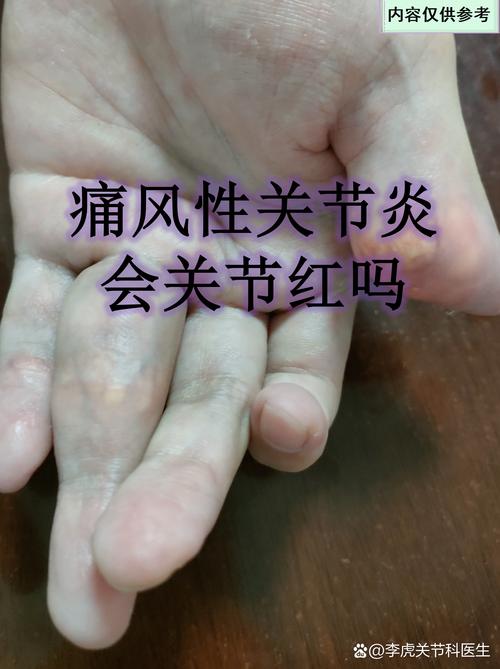 痛风与类风湿性关节炎