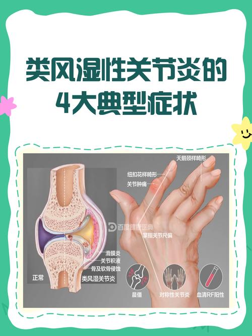 类风湿性关节炎的形成