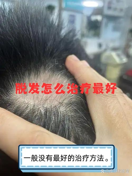 类风湿病人会掉头发吗