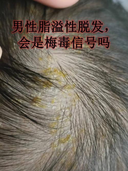 类风湿病人会掉头发吗