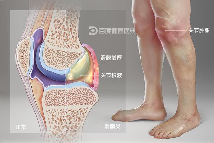 类风湿性关节炎滑膜炎