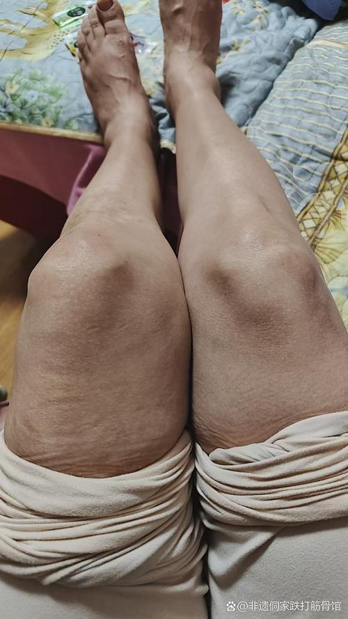 类风湿性关节炎滑膜炎