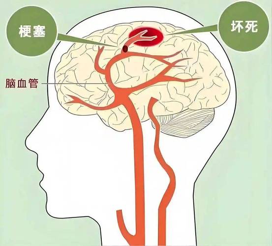 脑静脉血栓导致的脑梗