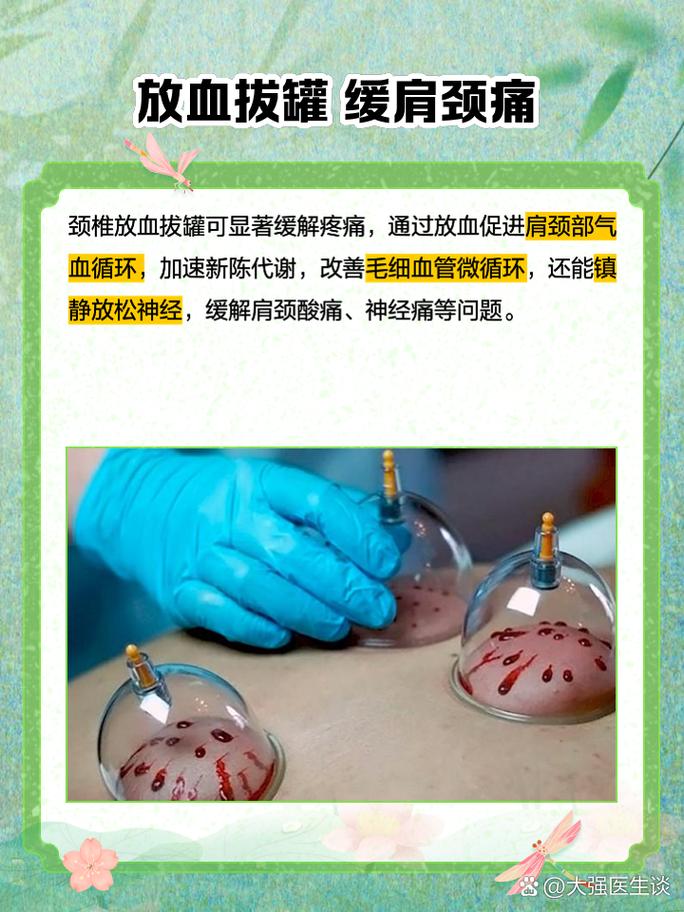 拔罐治疗风湿性关节炎