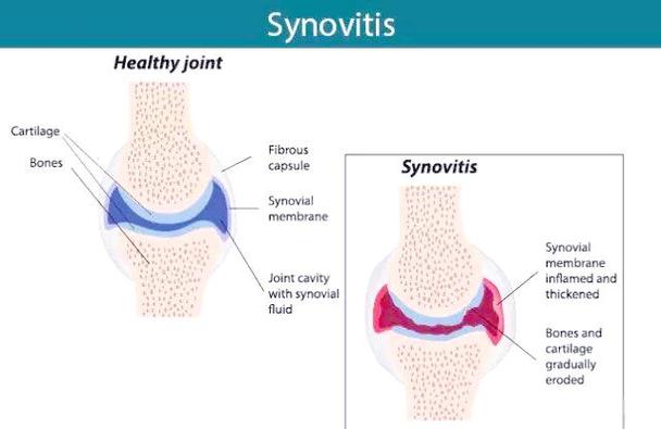 类风湿性关节炎 ra