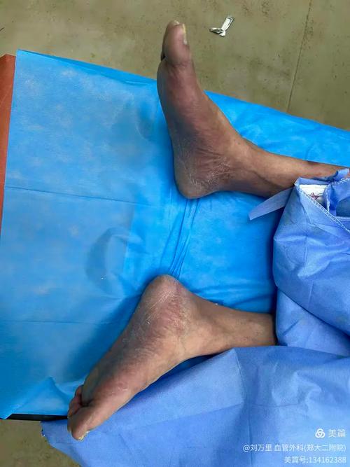 老年人心梗脑梗腿梗塞