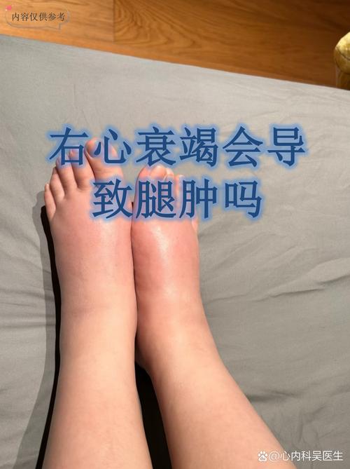 老年人心梗脑梗腿梗塞