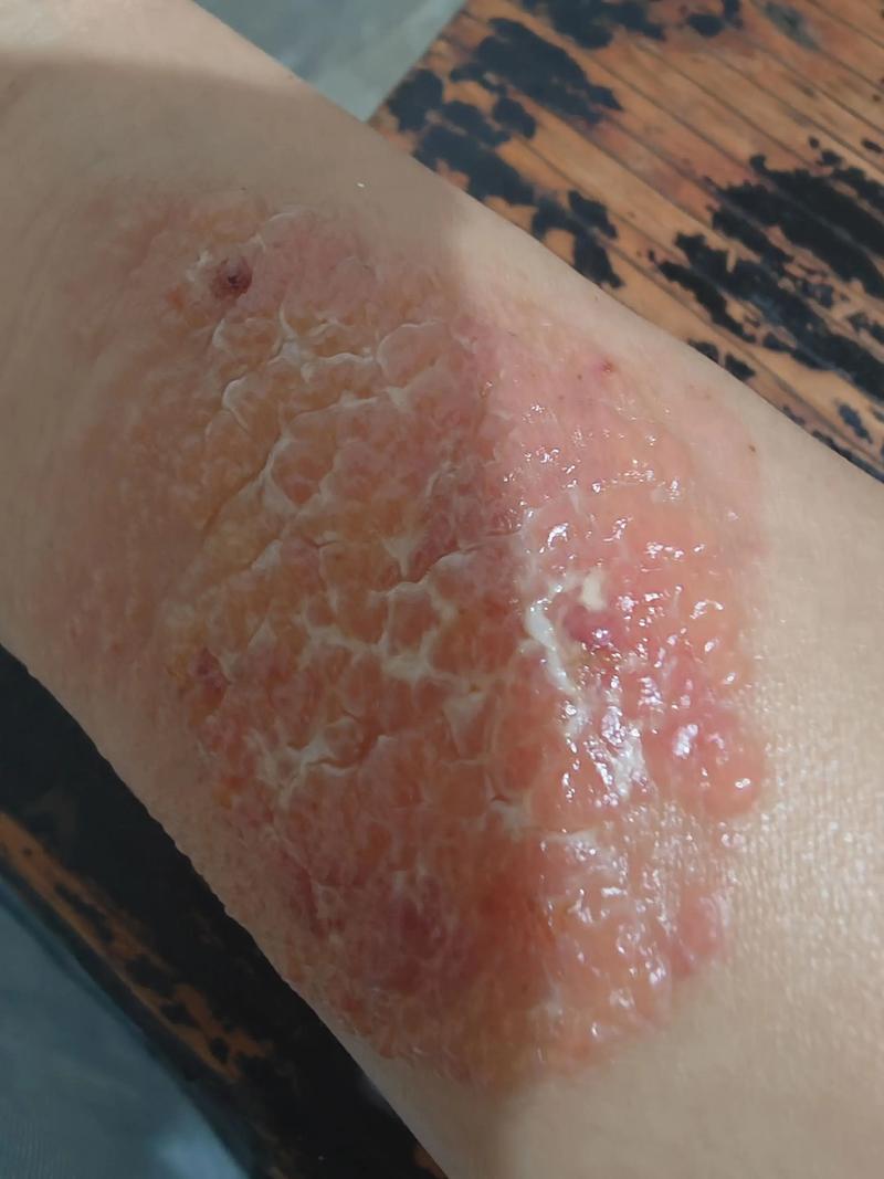 类风湿性关节炎 过敏