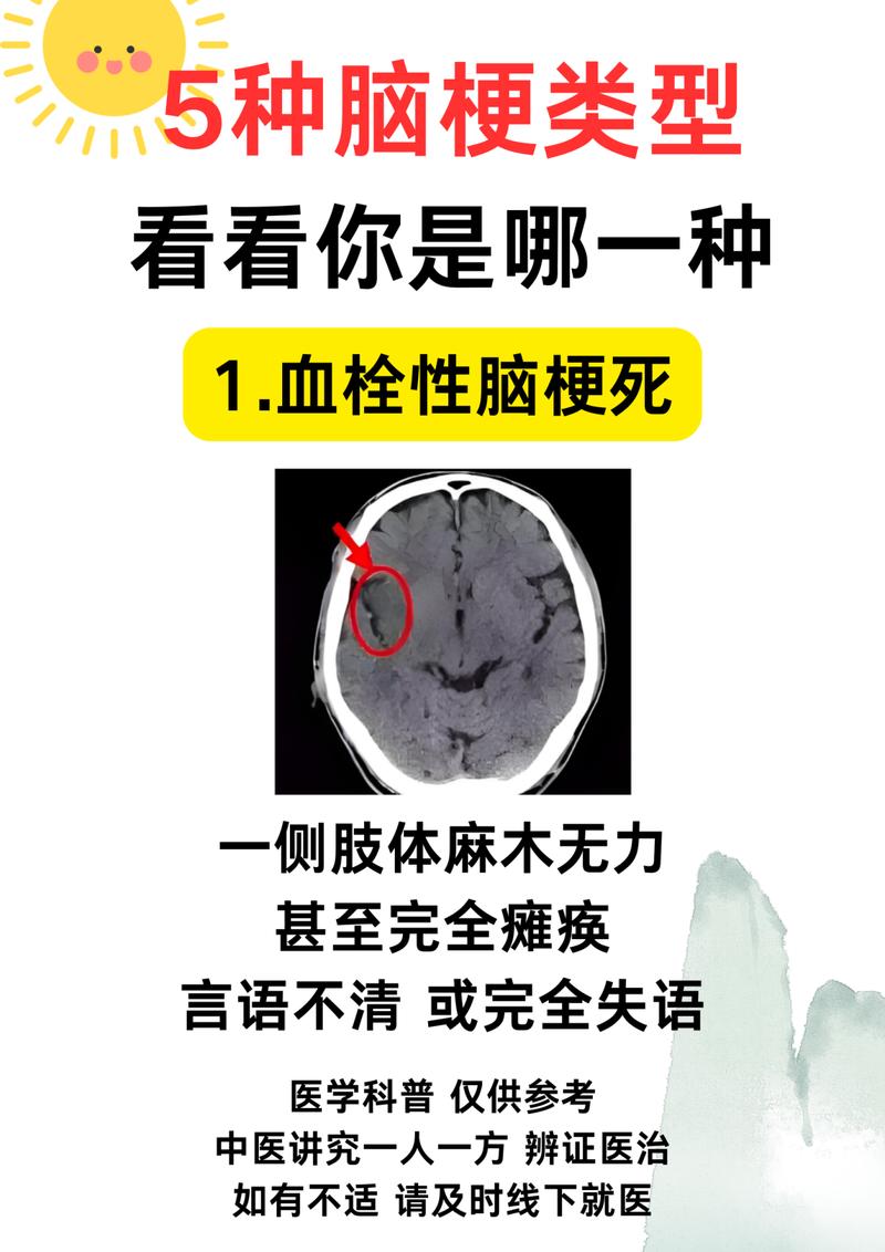 脑梗 失忆 精神错乱