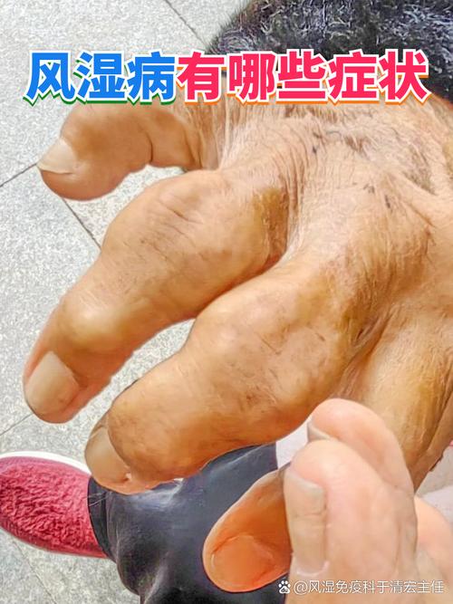 风湿性关节炎的人多吗