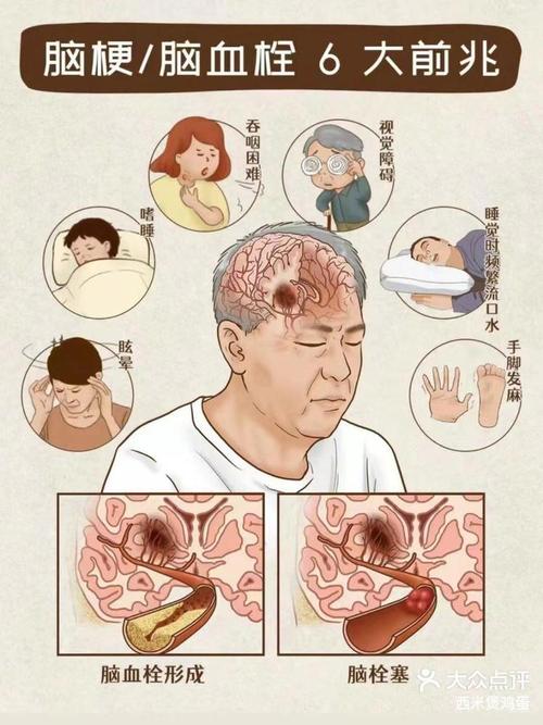 腔梗脑梗的症状有哪些