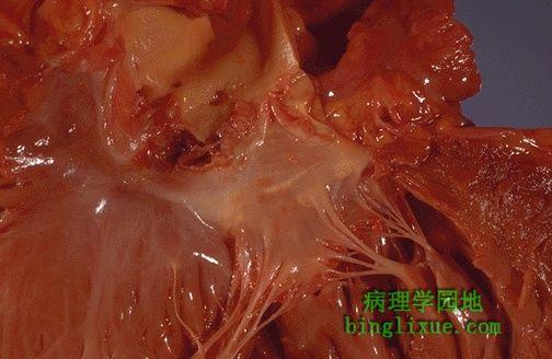 风湿性心内膜炎的血栓