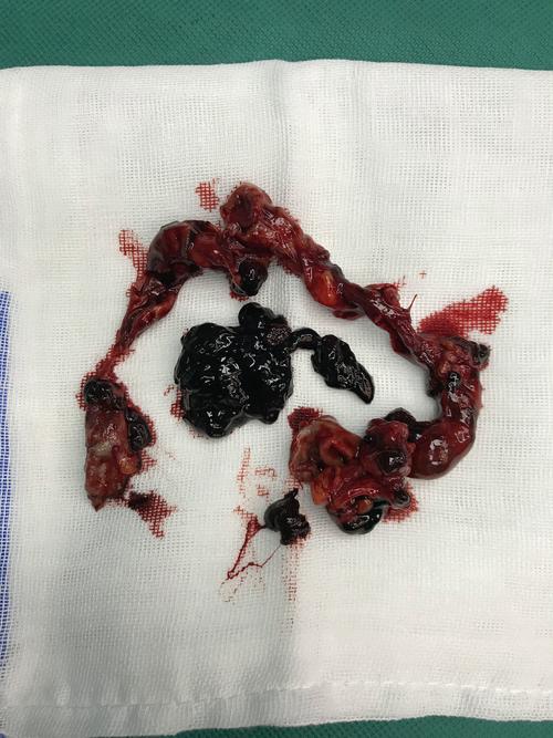 风湿性心内膜炎的血栓