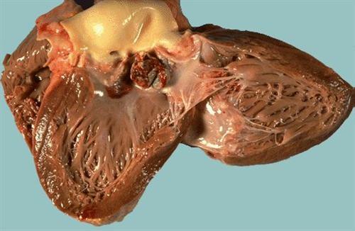 亚急性风湿性心内膜炎