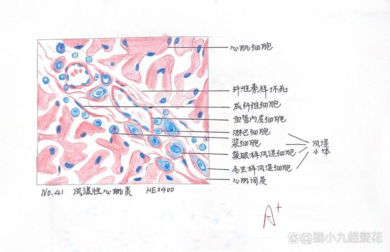 风湿性心肌炎病理学图