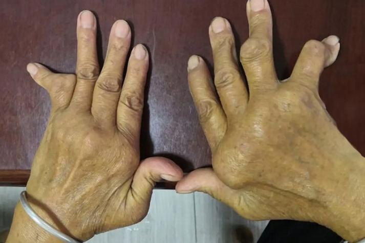 类风湿关节炎非活动期