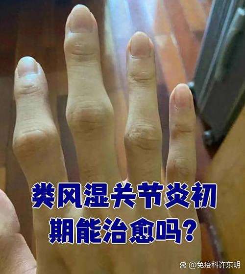 类风湿关节炎非活动期