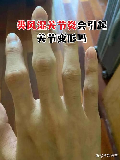 类风湿关节炎非活动期