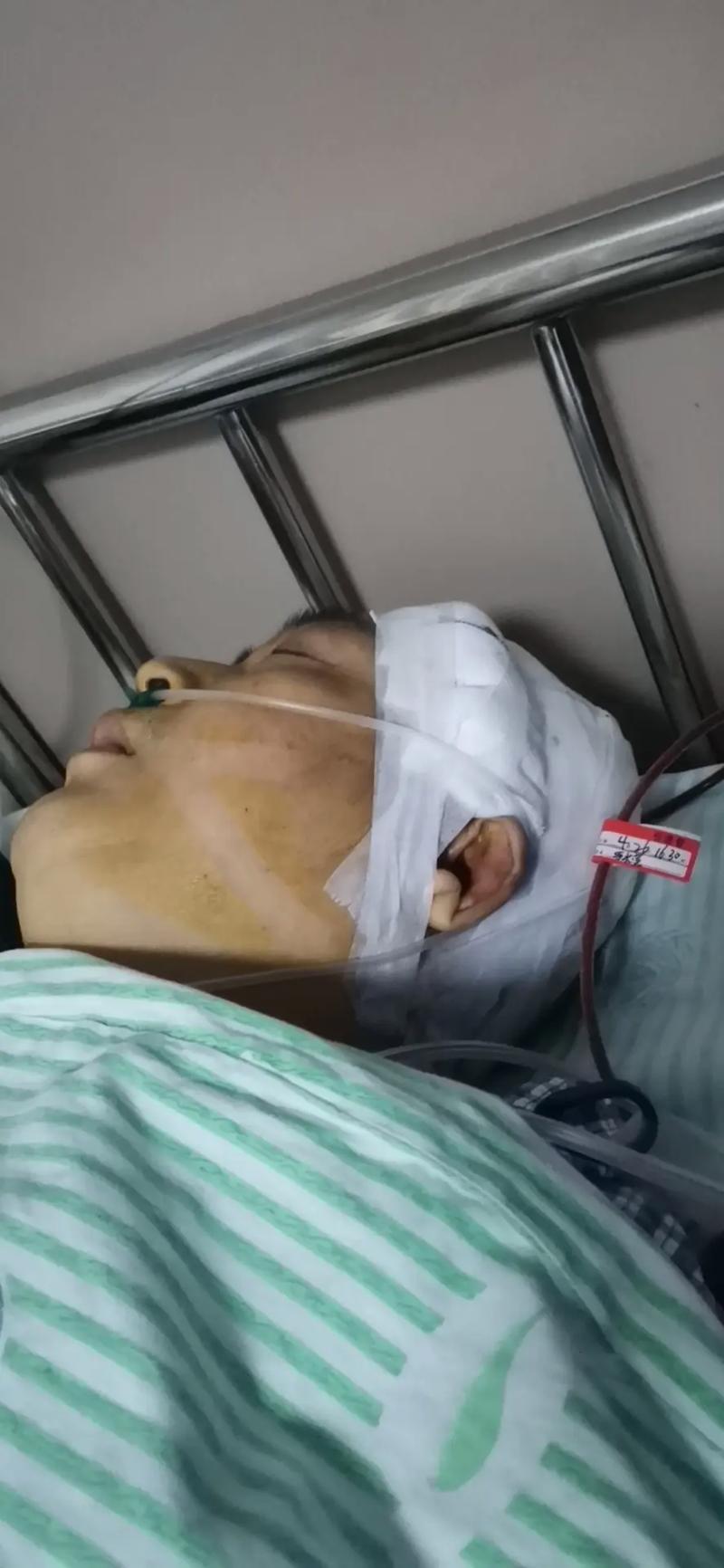 开颅手术 诱发 脑梗