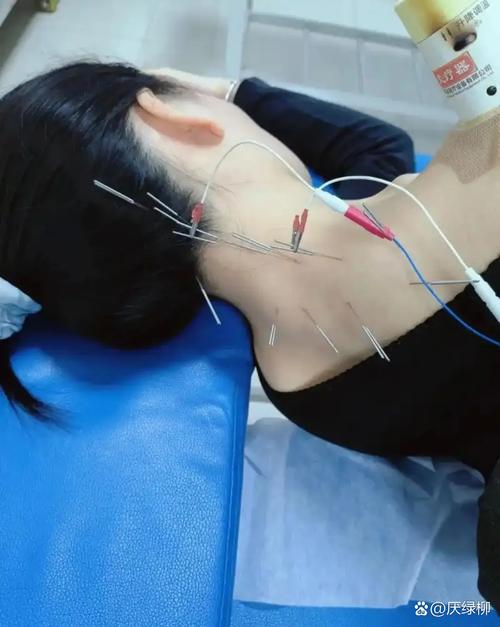 龙华医院 脑梗 针灸