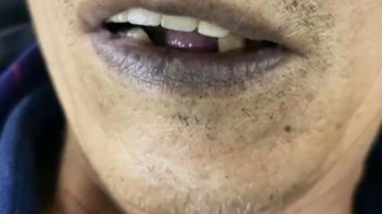 脑梗 睡觉 嘴唇发紫