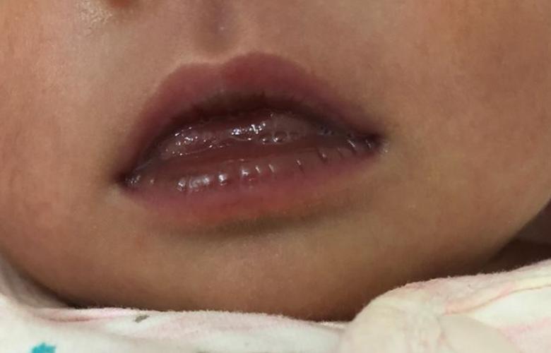 脑梗 睡觉 嘴唇发紫