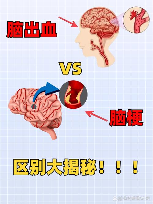 脑淤血是脑梗造成的吗