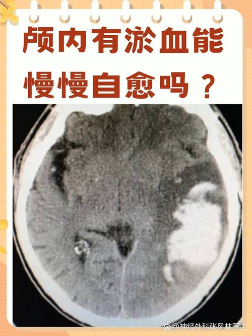 脑淤血是脑梗造成的吗