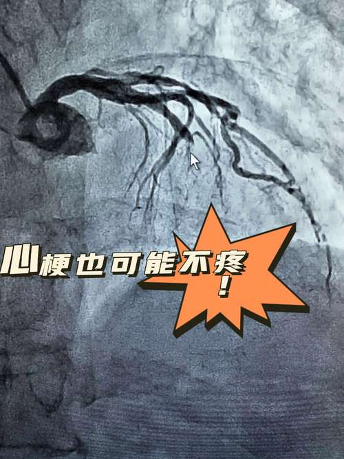 脑梗 放弃治疗 愧疚