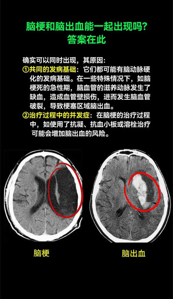 脑血流图能查出脑梗吗