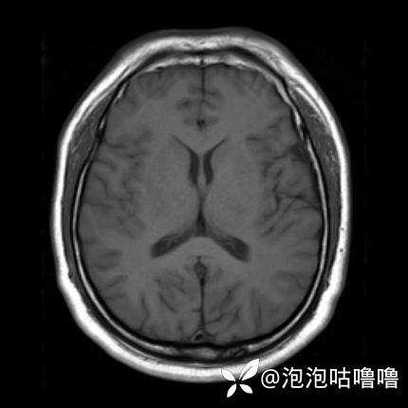 怎么看脑ct脑梗片子