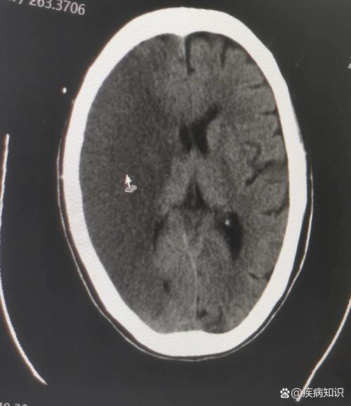 怎么看脑ct脑梗片子