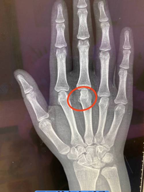 类风湿性关节炎 儿童