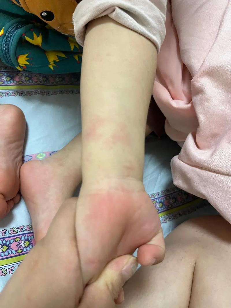 类风湿性关节炎 儿童