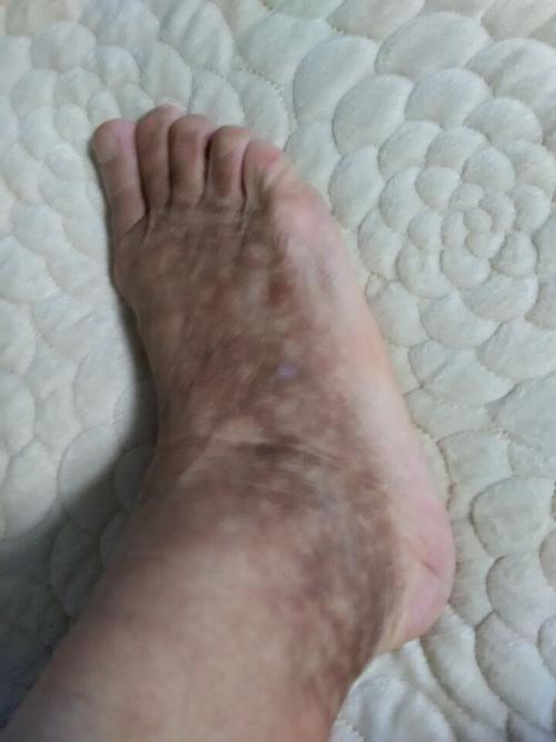 脚的关节风湿性关节炎