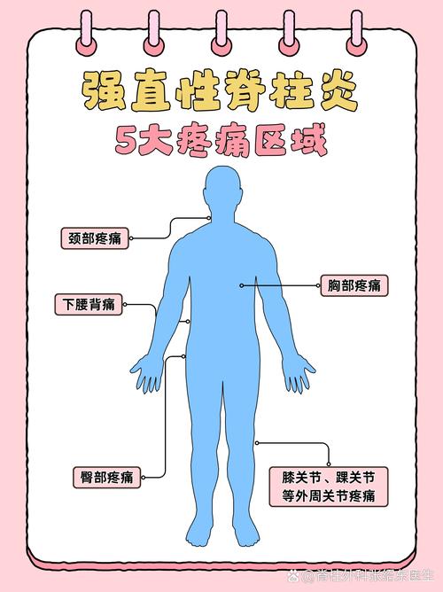 强直性脊柱炎跟类风湿