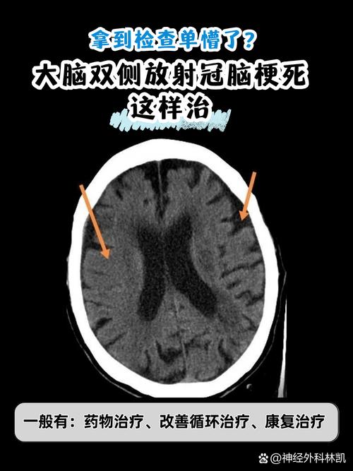 脑ct发现脑梗怎么办