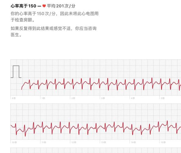 脑梗 心跳150以上