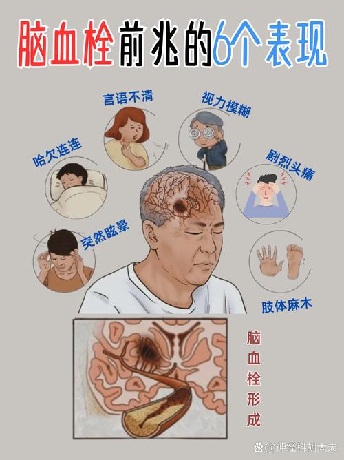 脑梗左脑堵快死的症状