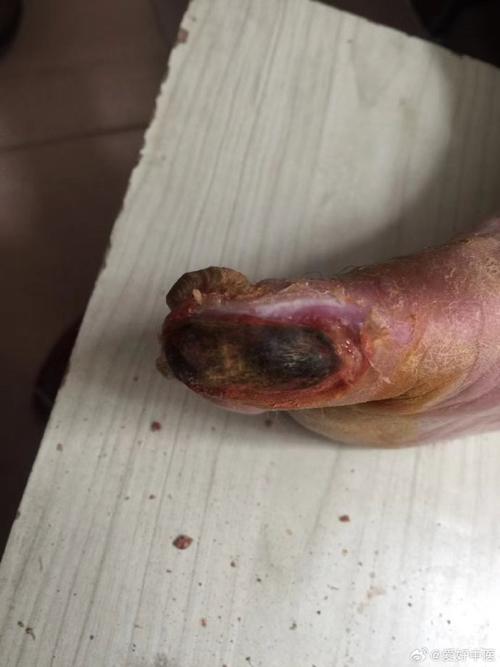 风湿病中纤维素样坏死