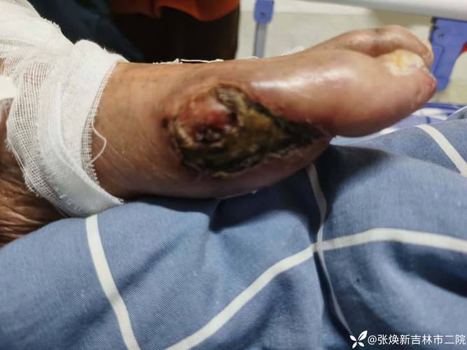 风湿病中纤维素样坏死