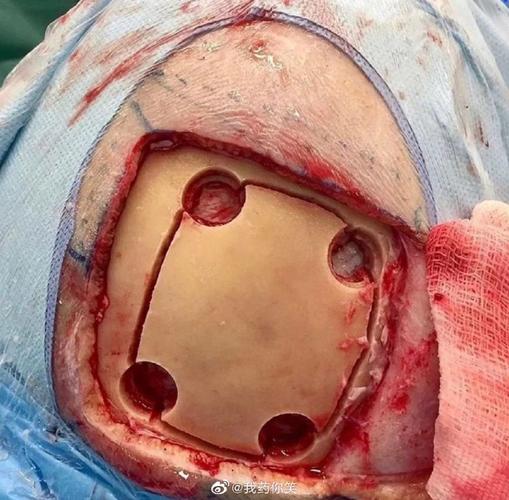 脑梗成脑疝前手术开颅