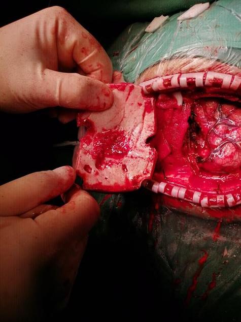 脑梗成脑疝前手术开颅