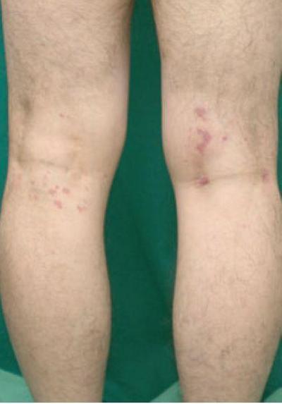 风湿性血管炎能活多久