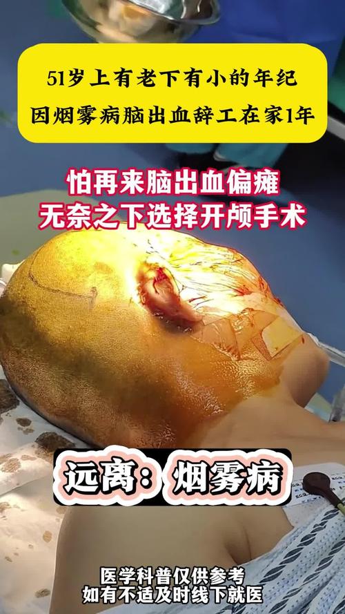 脑瘫脑梗脑中风脑淤血